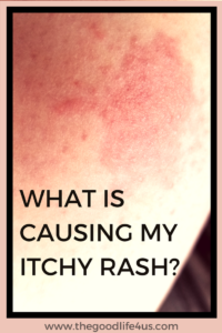 What is causing my itchy rash? - thegoodlife4us